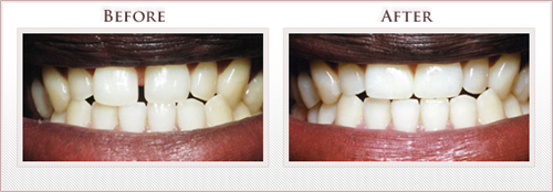 Before and After Photo